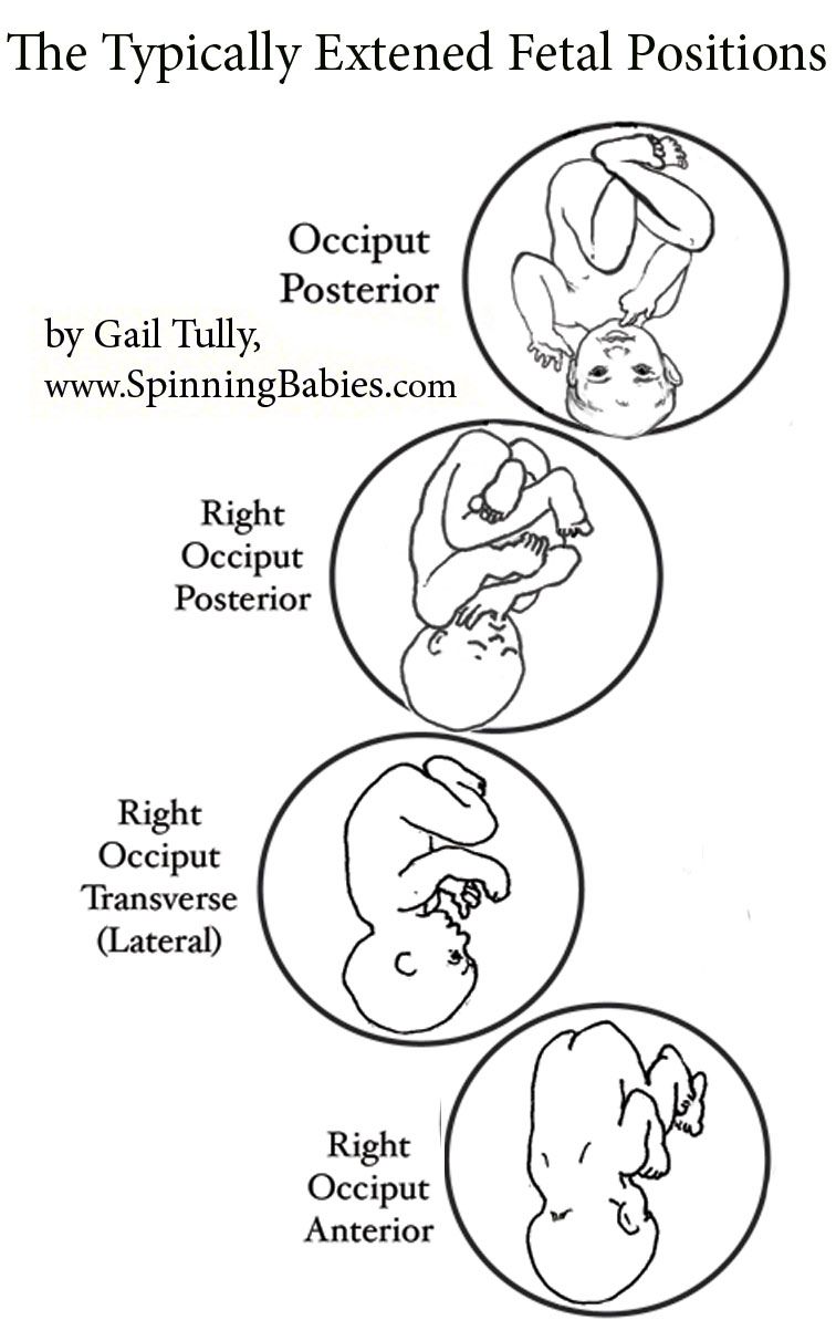 Persistent Posterior Presentation Spinning Babies
