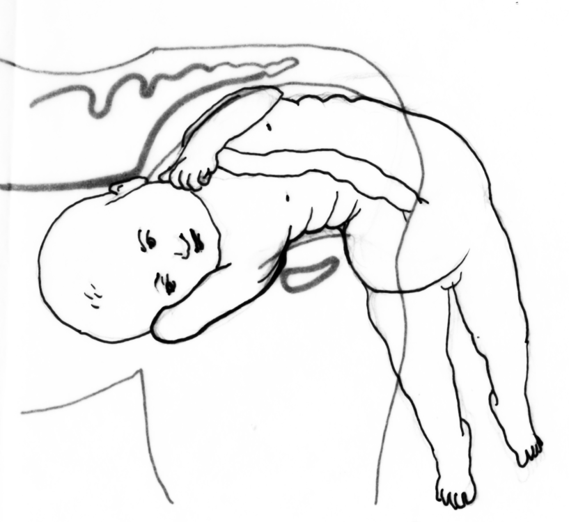 Spinning Babies® Approach to Breech Dystocia Spinning Babies