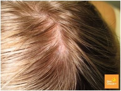 skin cancer scalp treatment